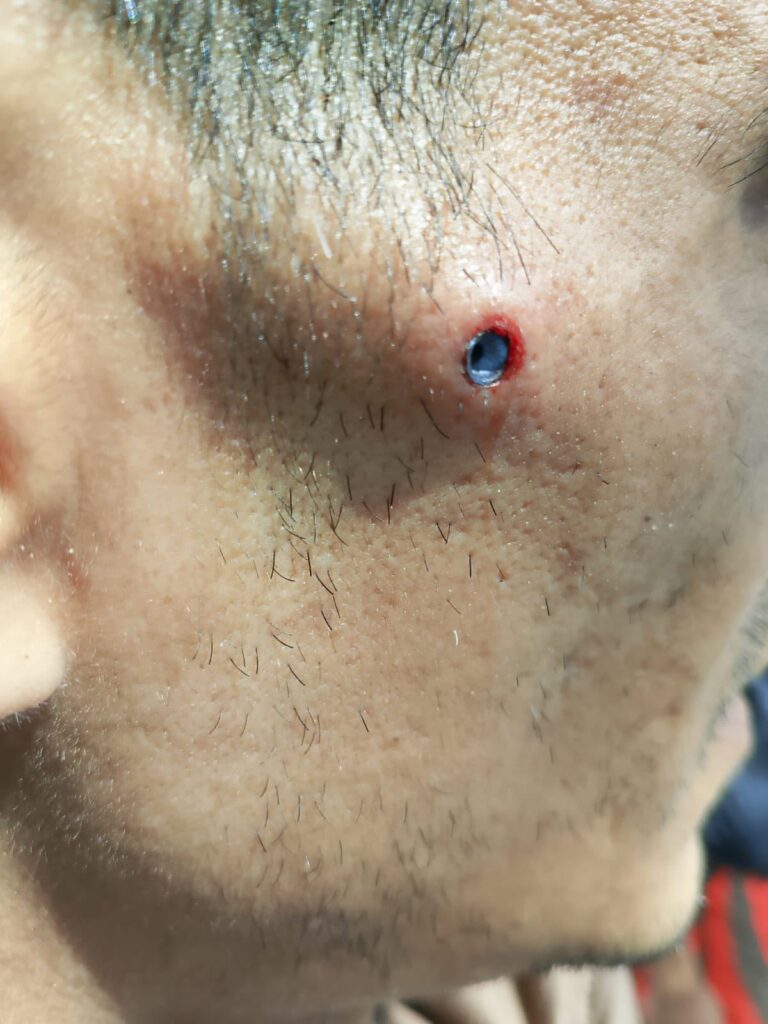 Ils dénoncent l'attaque d'un migrant avec une arme à air comprimé à Saint-Sébastien